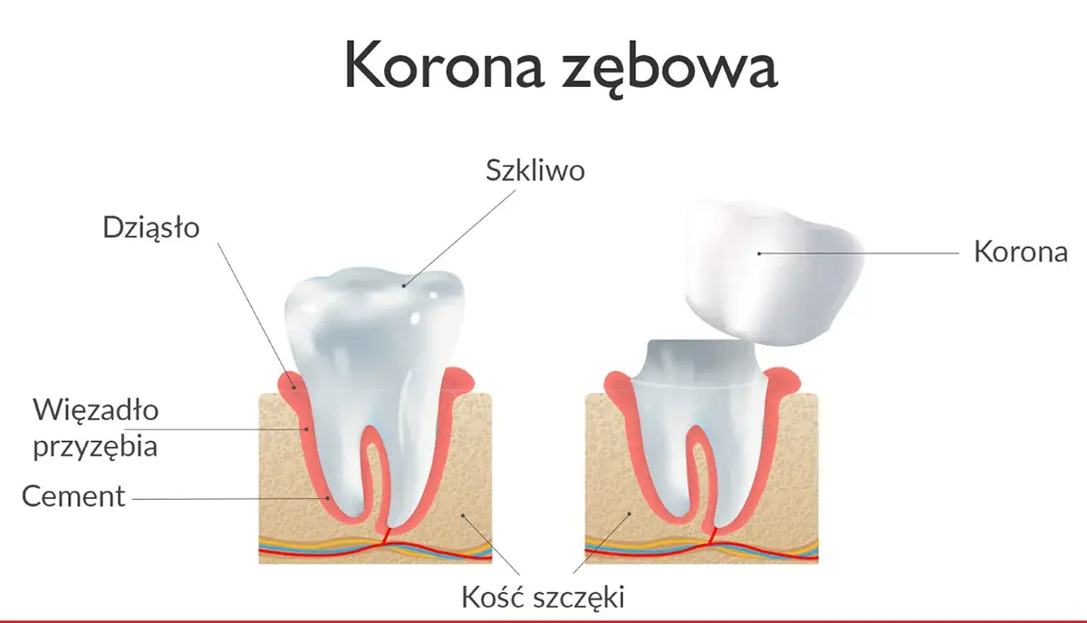 Protetyka stomatologiczna Łódź specjalizuje się w Koronie zewoa.