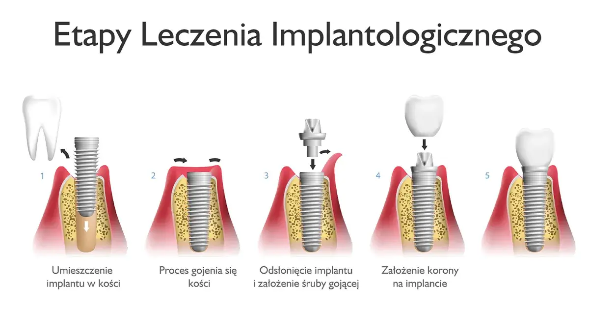 Etay specjalizuje się w implantologii stomatologicznej w Łodzi.