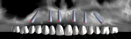 Obraz implantu dentystycznego w zębie.