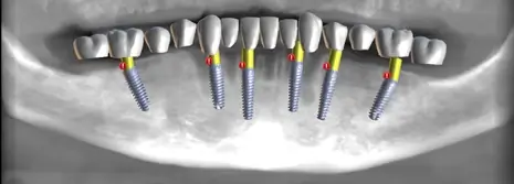 Zdjęcie rentgenowskie zębów i implantów dentystycznych pacjenta w Łodzi.
