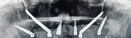 Zdjęcie rentgenowskie pacjenta z igłą w szyi wykonane podczas Implantoprotetyki w Łodzi.